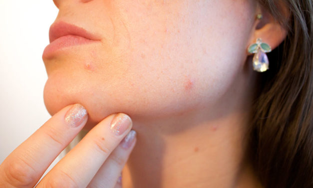 Why people with oily skin have acne and how to treat it