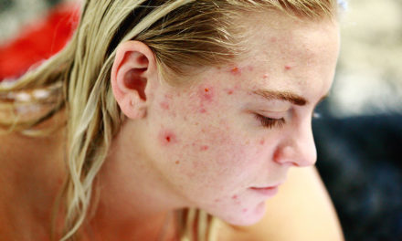Tips to clear up acne fast