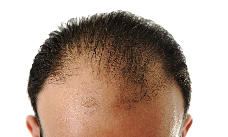 Do’s and Don’ts after a hair restoration procedure