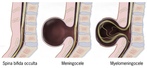 spina bifida occulta meningocele myelomeningocele